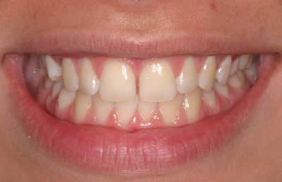 MockUp diastema closure